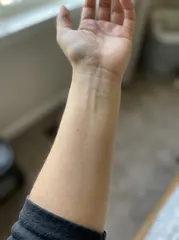 Sample photo: Inner forearm